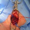 Carotid body tumour at Surgery 1