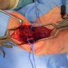 Carotid body tumour at Surgery 2