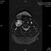 MRI of carotid Body Tumour