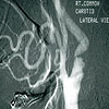 Carotid angiogram with stenosis