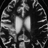 Brain scan of patient with stroke