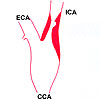 Narrowed internal carotid artery